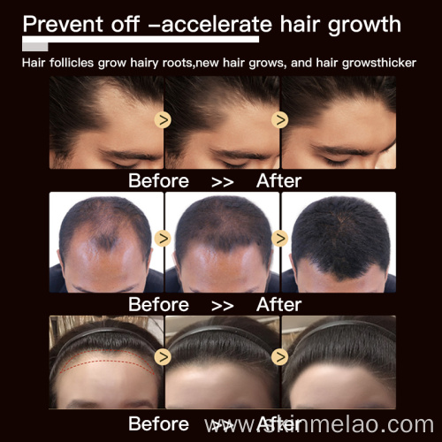 Anti Hair Loss Boosting Hair Growth Serum